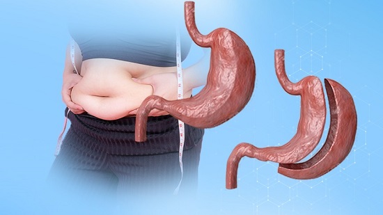 Prohibitions After Gastric Sleeve Surgery