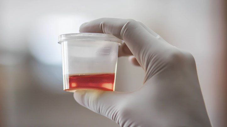 What is painless bloody urine