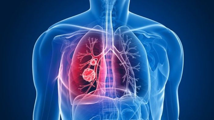 What is COPD?