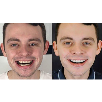 Before and after dental aesthetics