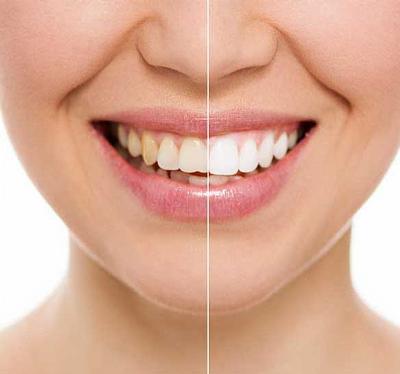 Before and after dental aesthetics