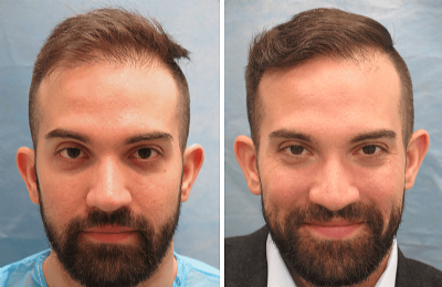 Before And After Hair Transplant