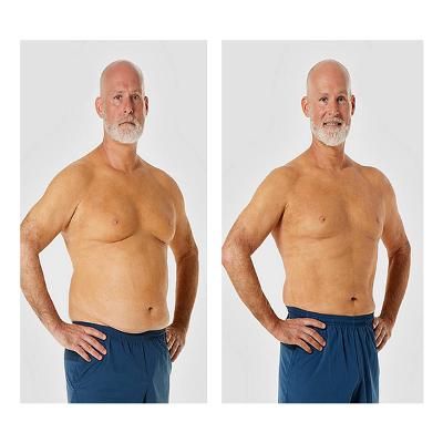 Before and after obesity surgery