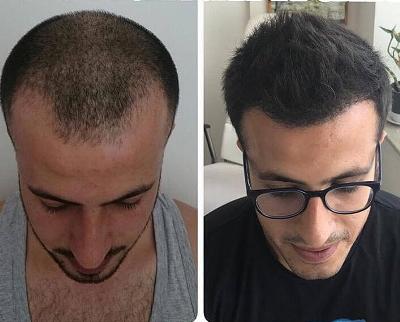 Before And After Hair Transplant