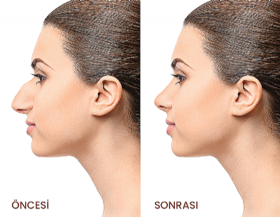 Before And After Aesthetic Surgery