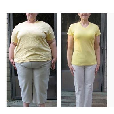 Before and after obesity surgery