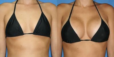 Before And After Breast Aesthetics