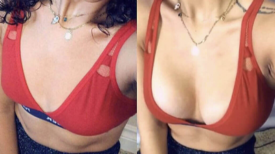 Before And After Breast Aesthetics