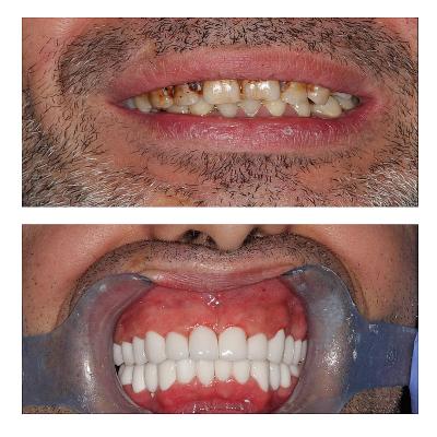Before and after dental aesthetics