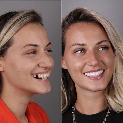 Before and after dental aesthetics