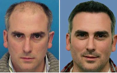 Before And After Hair Transplant
