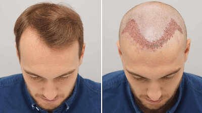 Before And After Hair Transplant
