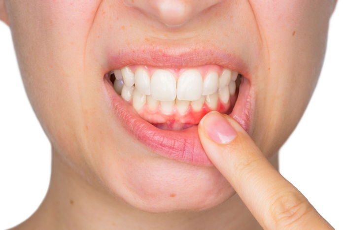 What is Bleeding Gums?